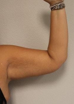 Arm Lift after at Kelly R. Kunkel, MD, PA in Fort Worth, TX