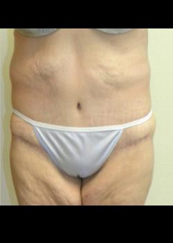 Kelly R. Kunkel, MD, PA tummy tuck after — Fort Worth, TX