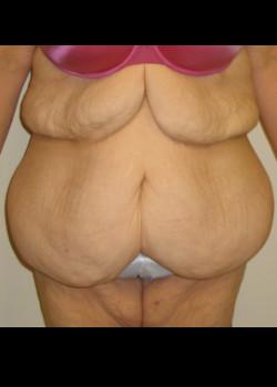 Tummy Tuck before at Kelly R. Kunkel, MD, PA in Fort Worth, TX