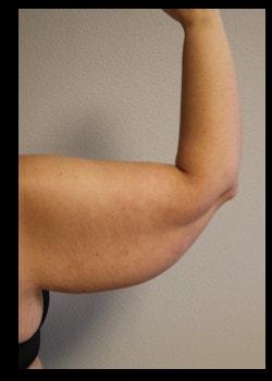 Arm Lift before at Kelly R. Kunkel, MD, PA in Fort Worth, TX