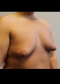 Breast Augmentation before at Kelly R. Kunkel, MD, PA in Fort Worth, TX
