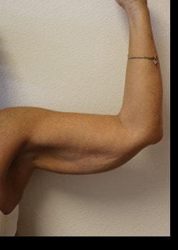 Arm Lift before at Kelly R. Kunkel, MD, PA in Fort Worth, TX