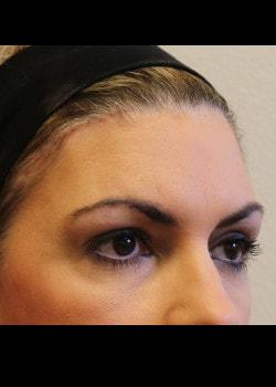 Brow Lift after at Kelly R. Kunkel, MD, PA in Fort Worth, TX