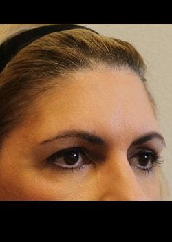 Brow Lift before at Kelly R. Kunkel, MD, PA in Fort Worth, TX
