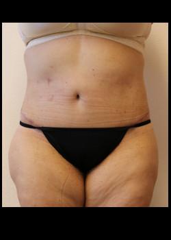Kelly R. Kunkel, MD, PA tummy tuck after — Fort Worth, TX