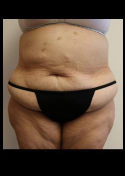 Tummy Tuck before at Kelly R. Kunkel, MD, PA in Fort Worth, TX