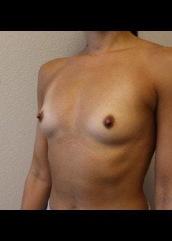 Breast Augmentation before at Kelly R. Kunkel, MD, PA in Fort Worth, TX