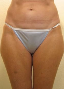 Tummy Tuck before at Kelly R. Kunkel, MD, PA in Fort Worth, TX