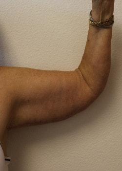 Arm Lift after at Kelly R. Kunkel, MD, PA in Fort Worth, TX