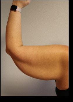 Arm Lift before at Kelly R. Kunkel, MD, PA in Fort Worth, TX