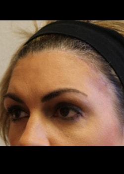 Brow Lift after at Kelly R. Kunkel, MD, PA in Fort Worth, TX