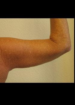 Arm Lift after at Kelly R. Kunkel, MD, PA in Fort Worth, TX