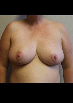 Breast Reduction after at Kelly R. Kunkel, MD, PA in Fort Worth, TX