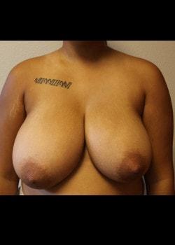 Breast Reduction before at Kelly R. Kunkel, MD, PA in Fort Worth, TX