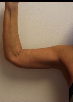 Arm Lift after at Kelly R. Kunkel, MD, PA in Fort Worth, TX