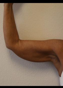 Arm Lift before at Kelly R. Kunkel, MD, PA in Fort Worth, TX