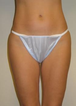 Liposuction after at Kelly R. Kunkel, MD, PA in Fort Worth, TX