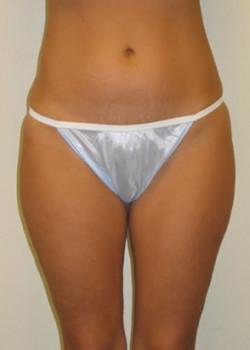 Liposuction before at Kelly R. Kunkel, MD, PA in Fort Worth, TX