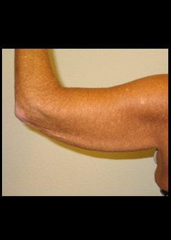 Arm Lift before at Kelly R. Kunkel, MD, PA in Fort Worth, TX