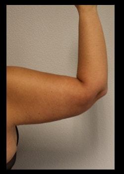 Arm Lift after at Kelly R. Kunkel, MD, PA in Fort Worth, TX