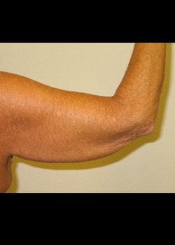 Arm Lift before at Kelly R. Kunkel, MD, PA in Fort Worth, TX