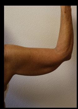 Arm Lift before at Kelly R. Kunkel, MD, PA in Fort Worth, TX