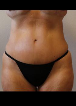 Tummy Tuck after at Kelly R. Kunkel, MD, PA in Fort Worth, TX