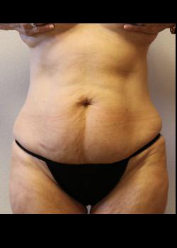 Tummy Tuck before at Kelly R. Kunkel, MD, PA in Fort Worth, TX