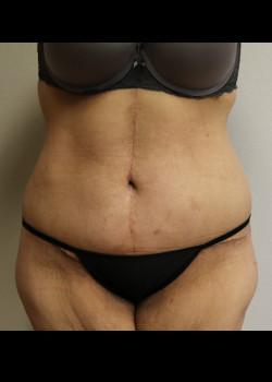 Kelly R. Kunkel, MD, PA tummy tuck after — Fort Worth, TX