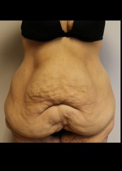 Tummy Tuck before at Kelly R. Kunkel, MD, PA in Fort Worth, TX