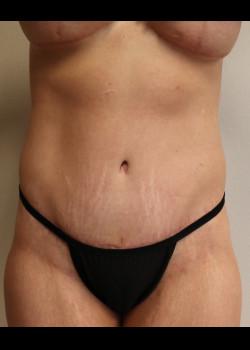 Kelly R. Kunkel, MD, PA tummy tuck after — Fort Worth, TX