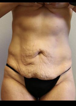 Tummy Tuck before at Kelly R. Kunkel, MD, PA in Fort Worth, TX