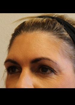 Brow Lift before at Kelly R. Kunkel, MD, PA in Fort Worth, TX