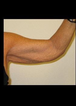 Arm Lift before at Kelly R. Kunkel, MD, PA in Fort Worth, TX