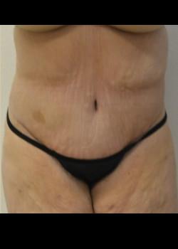 Kelly R. Kunkel, MD, PA tummy tuck after — Fort Worth, TX