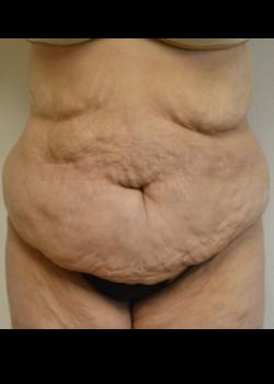 Tummy Tuck before at Kelly R. Kunkel, MD, PA in Fort Worth, TX