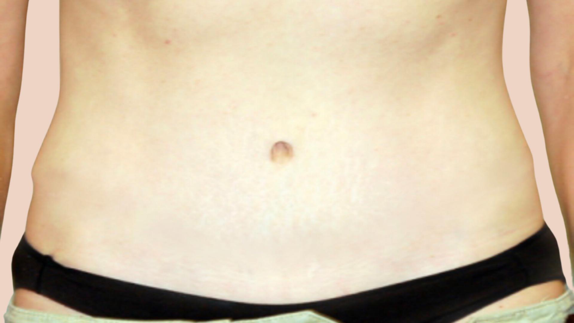 David Mosier, M.D., P.A. tummy tuck after — Austin, TX