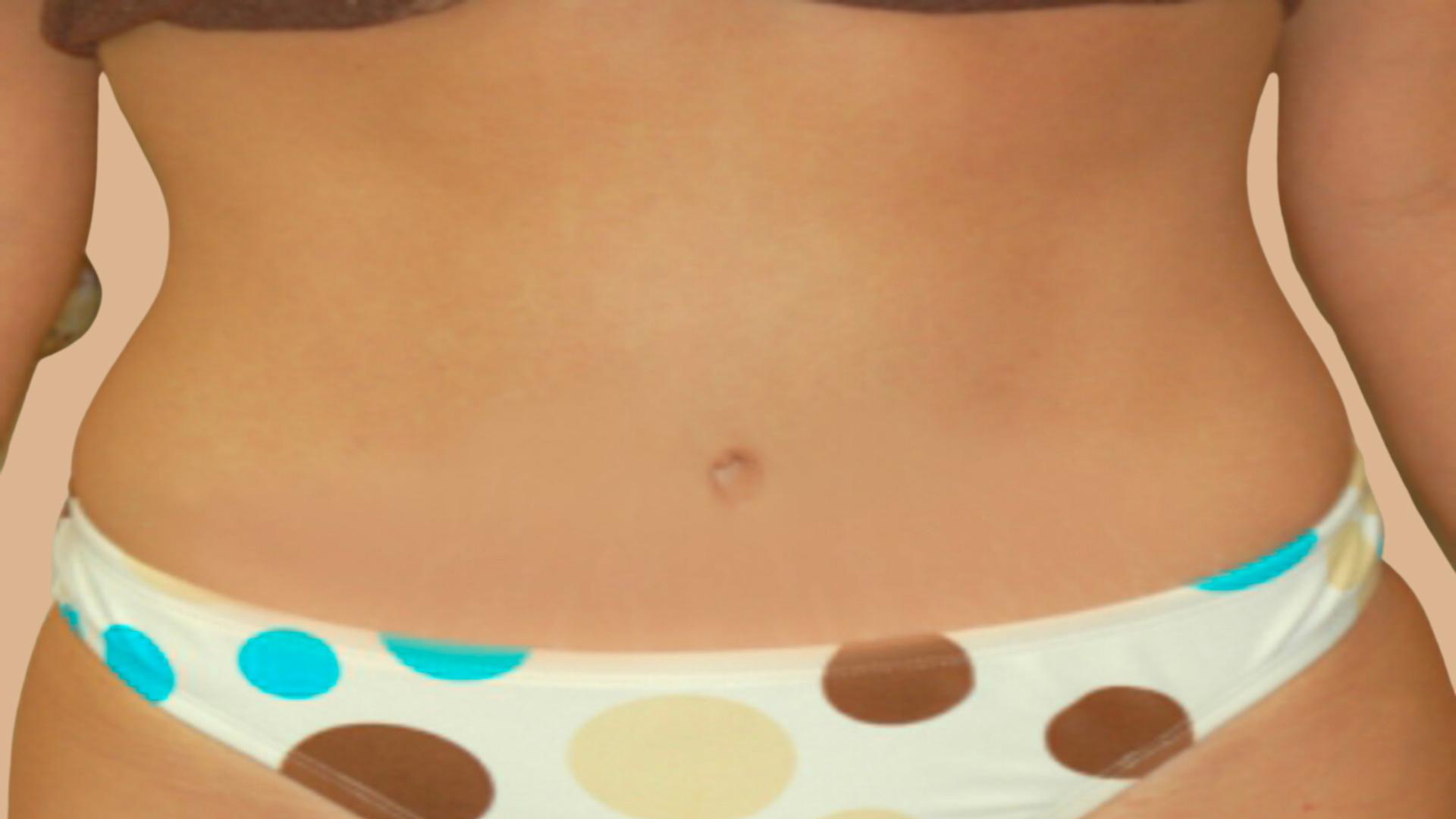 David Mosier, M.D., P.A. tummy tuck after — Austin, TX