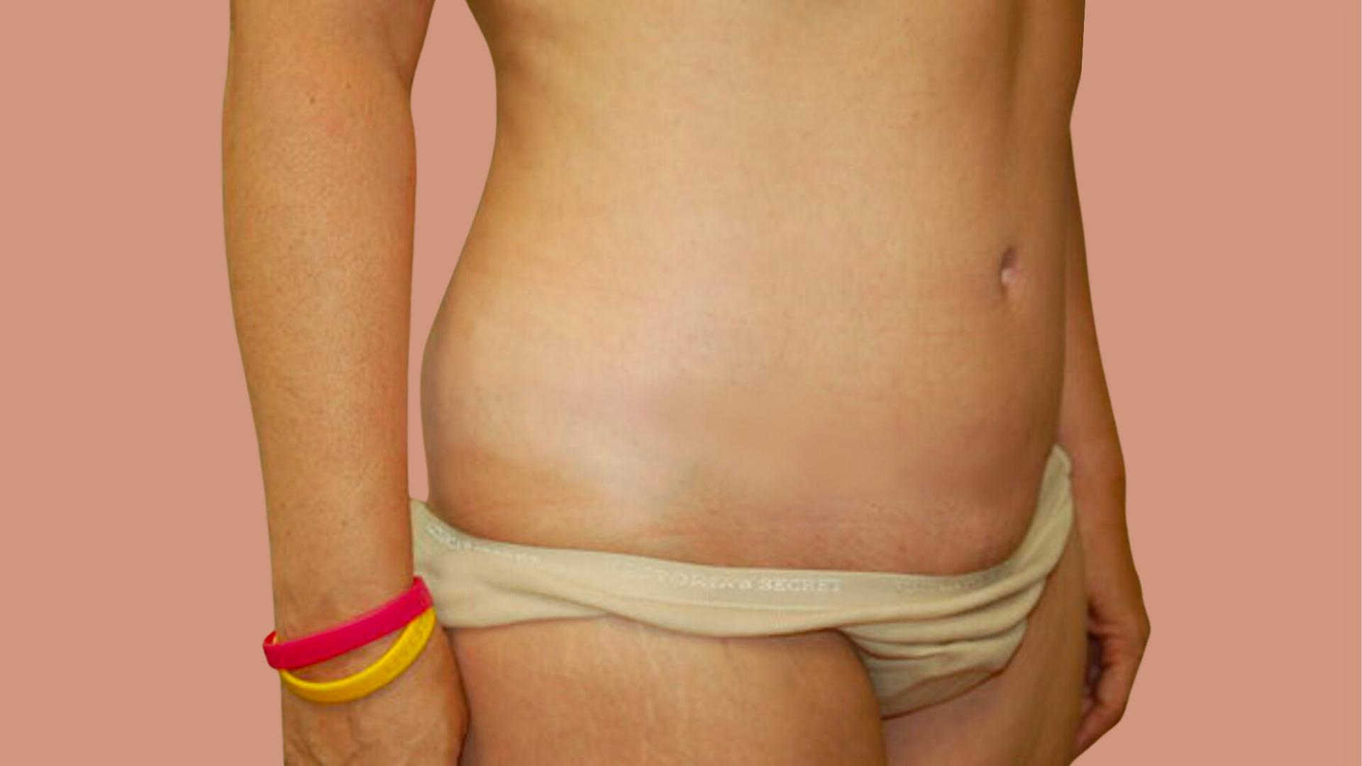 David Mosier, M.D., P.A. tummy tuck after — Austin, TX