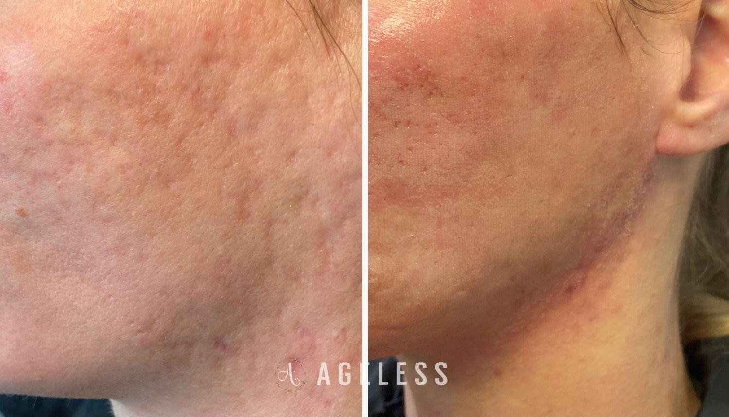 Ageless Aesthetics laser treatment result — Indianapolis, IN