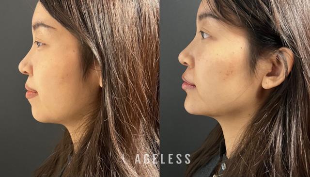 Lip Filler result at Ageless Aesthetics in Indianapolis, IN