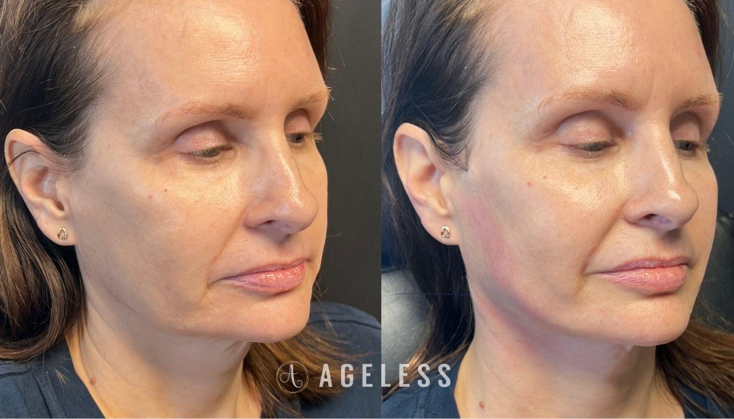 Ageless Aesthetics result — Indianapolis, IN