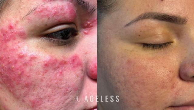 Laser Skin Resurfacing result at Ageless Aesthetics in Indianapolis, IN