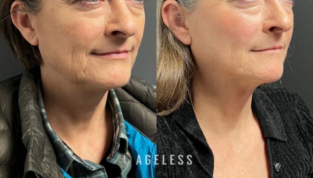 Deep Plane Facelift result at Ageless Aesthetics in Indianapolis, IN