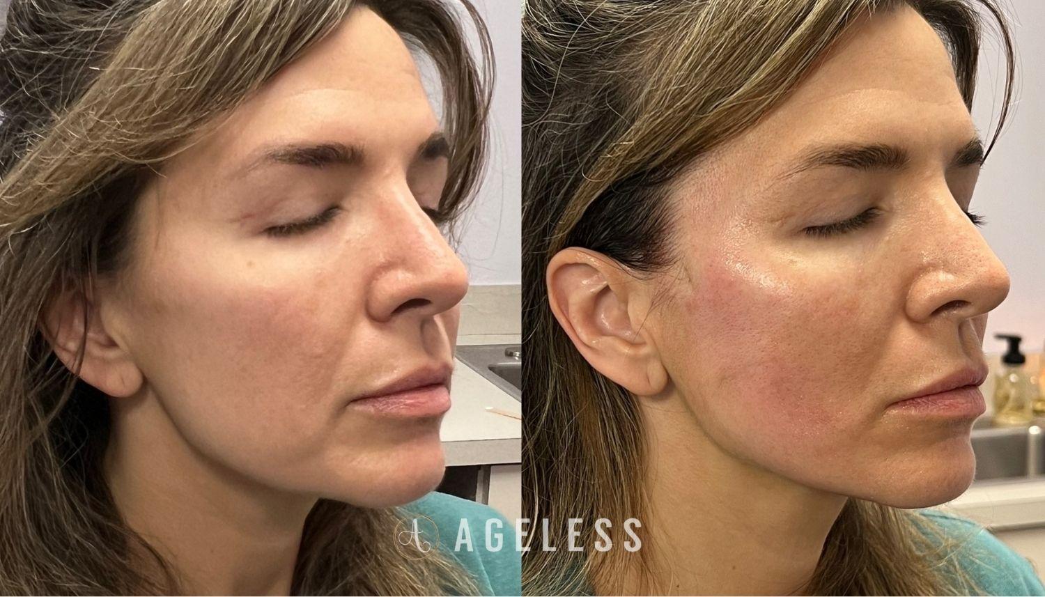 Ageless Aesthetics result — Indianapolis, IN