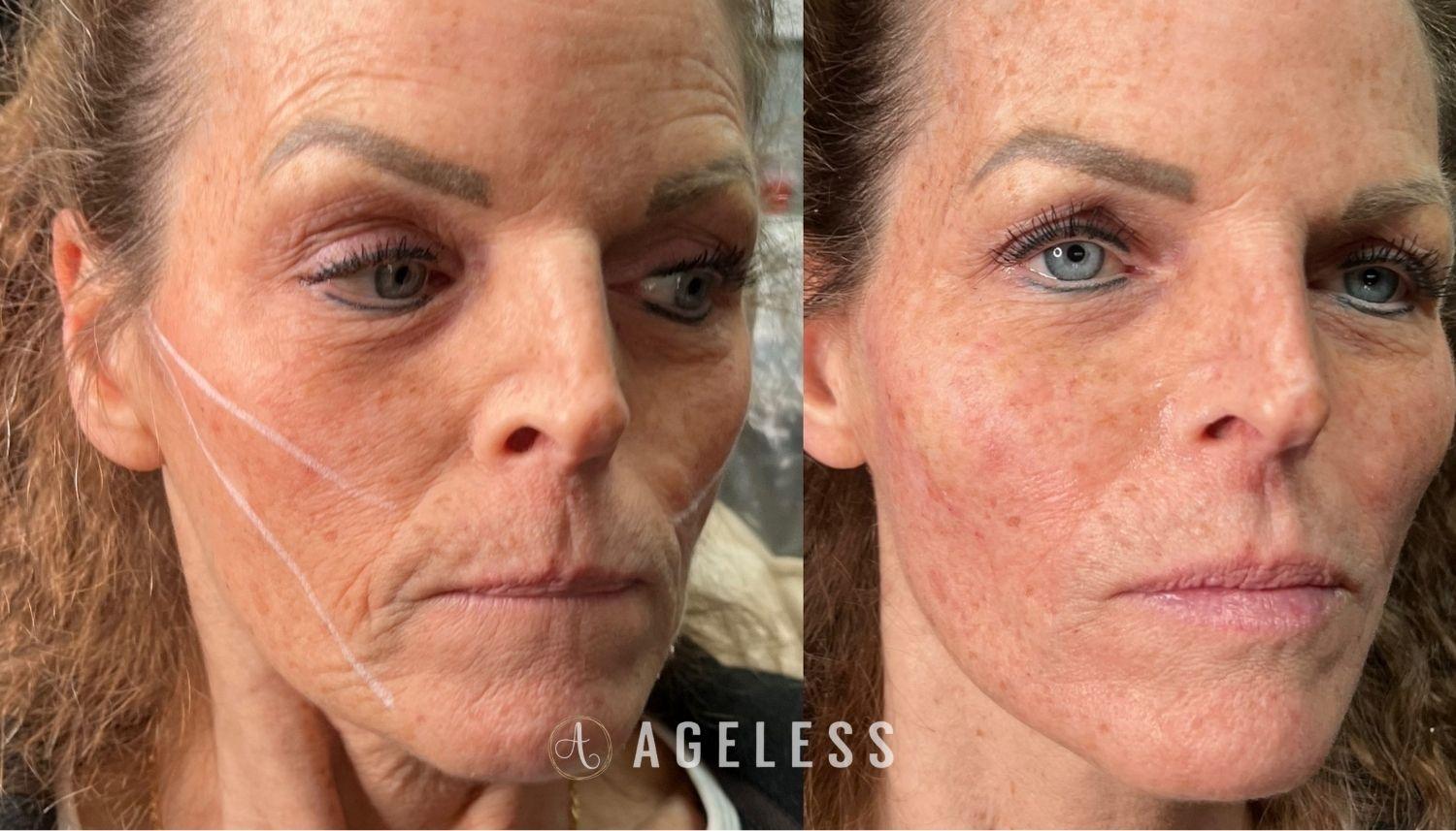 Ageless Aesthetics result — Indianapolis, IN
