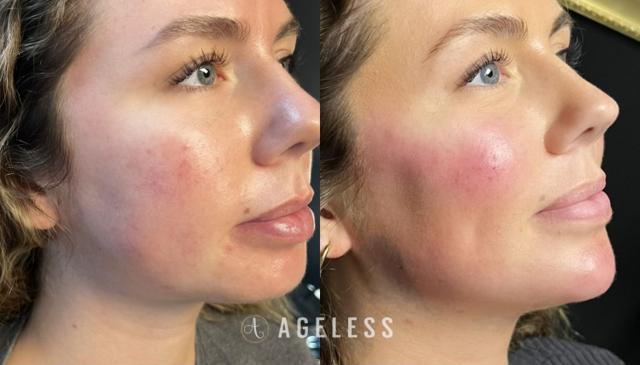Lip Filler result at Ageless Aesthetics in Indianapolis, IN