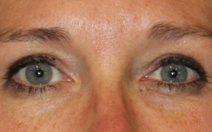 Dami Lee, DO brow lift after — Denver, CO