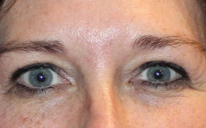 Brow Lift before at Dami Lee, DO in Denver, CO