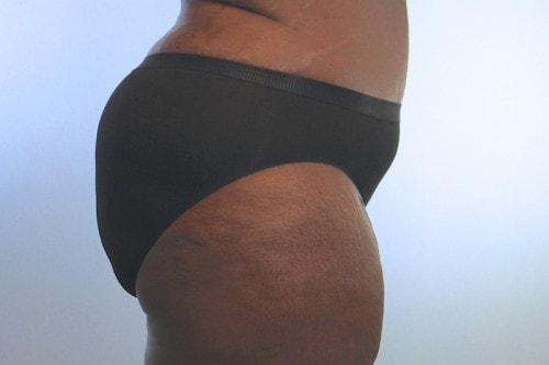 Kristi Hustak, MD bbl after — Houston, TX